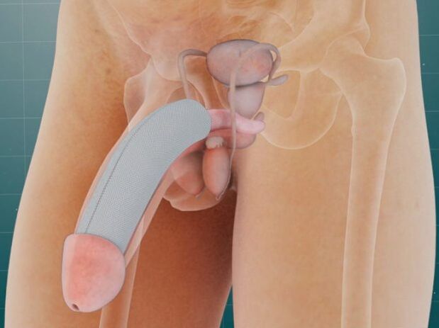 Penis after insertion of a special implant under the skin